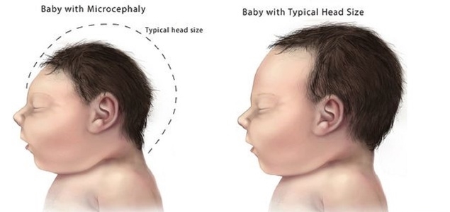 zika-cefalia-embarazo.jpg