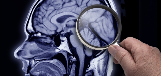 Cerebro-lupa-Alzheimer-635-GETTY.jpg