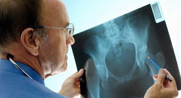 osteoporosis-770.jpg