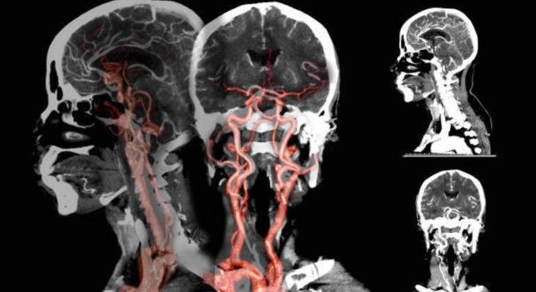 cerebrovascular-radiofgrafia-770.jpg