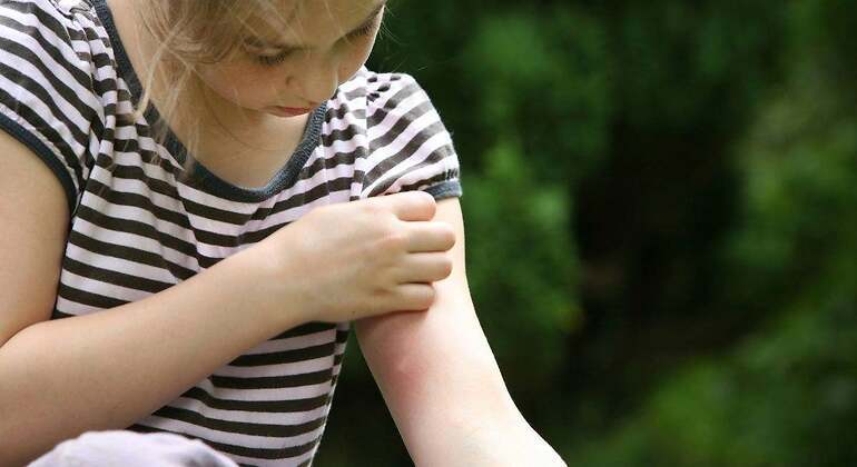 Una niña se rasca el brazo porque le pica mucho por la picadura de un mosquito